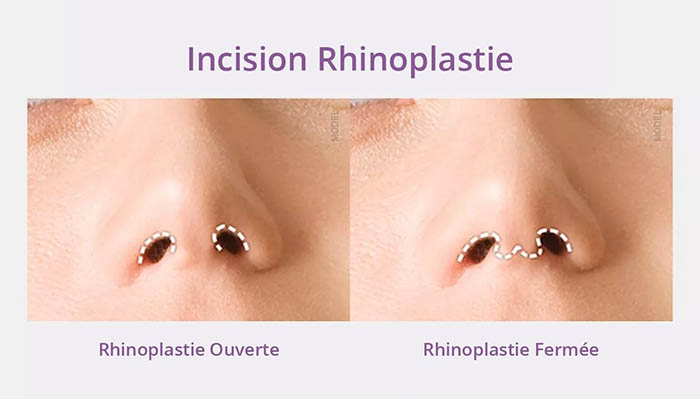 Rhinoplastie ouverte vs fermee