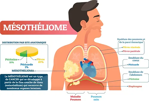 Mésothéliome mésothéliome