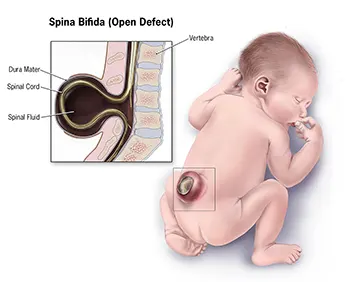 maladie spina bifida