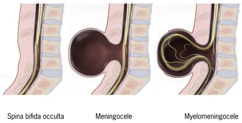 types spina bifida