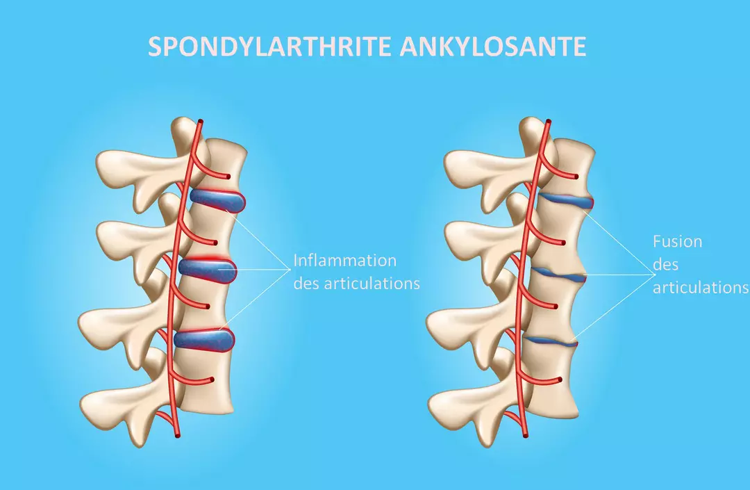 la spondylarthrite ankylosante symptômes