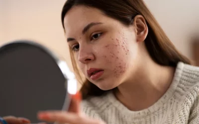 Acné hormonale : qu’est-ce que c’est ? Comment traiter ?