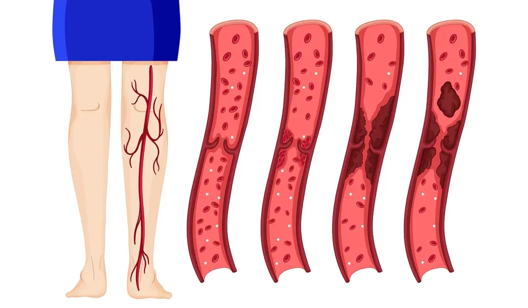Varices : causes et traitements
